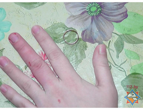 В Гомеле спасатели помогли женщине снять кольцо с пальца